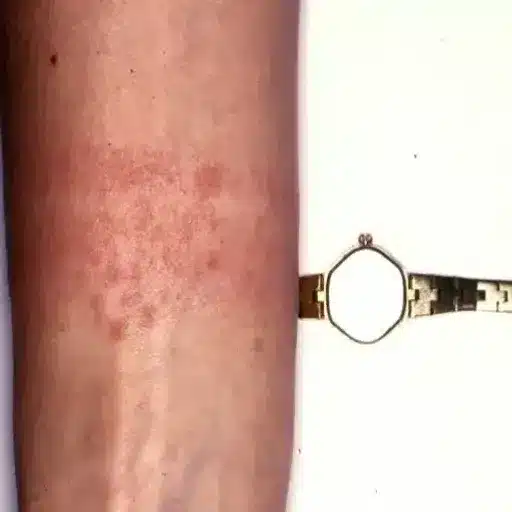 Stainless Steel and Sensitive Skin